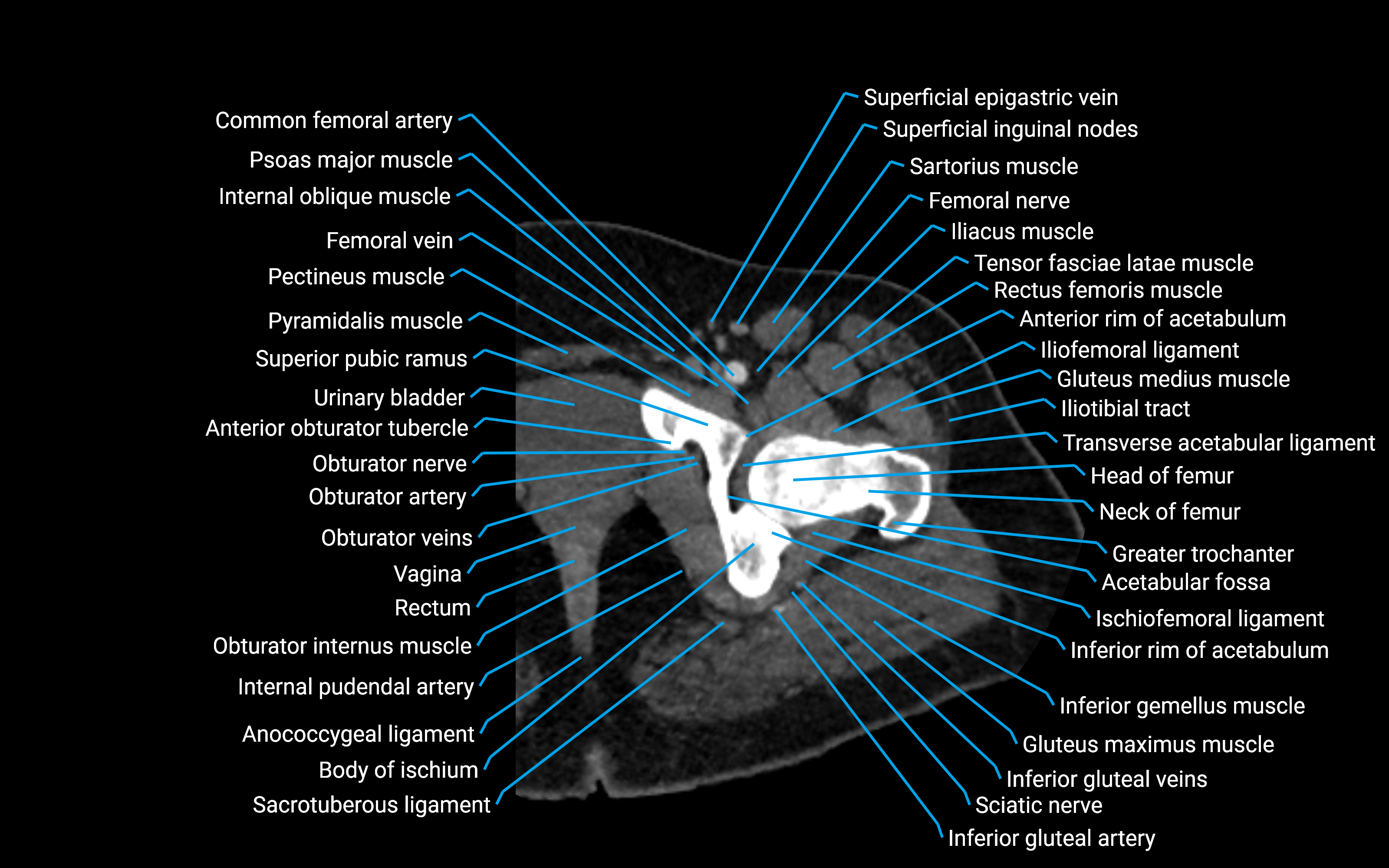 CT Hip axial cross sectional anatomy labelled image 10 (1).png